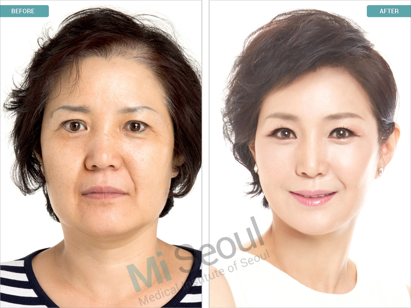 Korea Plastic Surgery Before and After photos