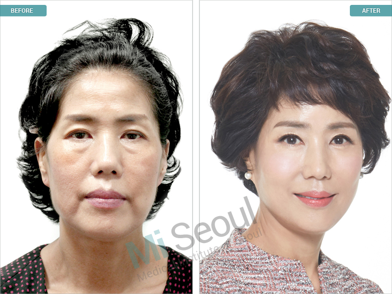 Korea Plastic Surgery Before And After Photos