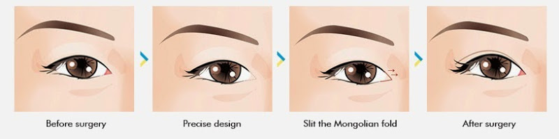 7 epicanthoplasty