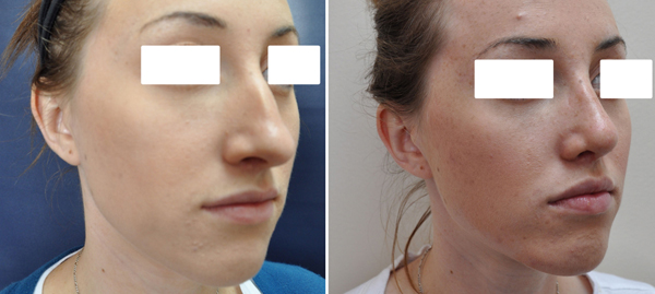 rhinoplasty_1