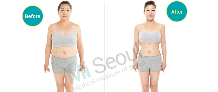 Liposuction & Body Contouring