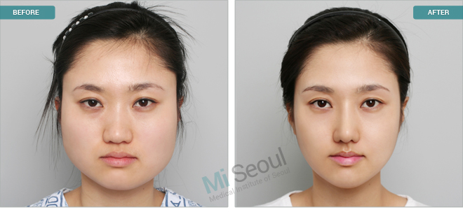 korean plastic surgery before and after gone wrong
