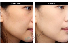 whitening-before-and-after1
